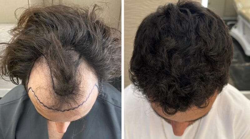 Inovações ajudam a popularizar busca por transplante capilar