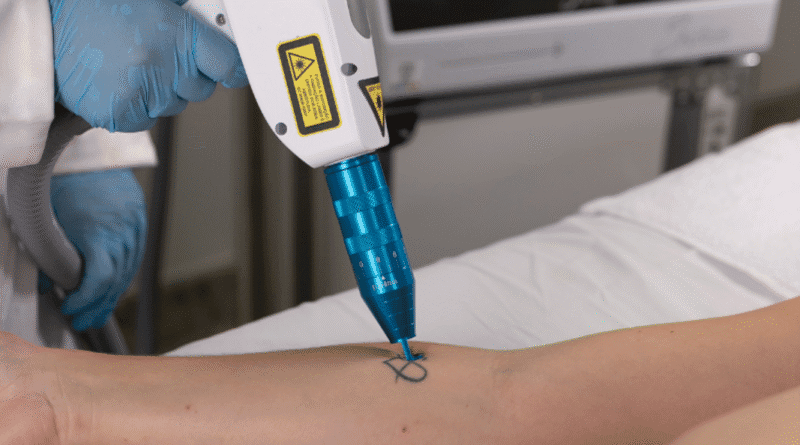 Procura por remoção de tatuagens cresce no Brasil