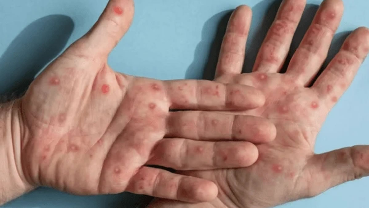 Mpox volta a acender alerta no Brasil
