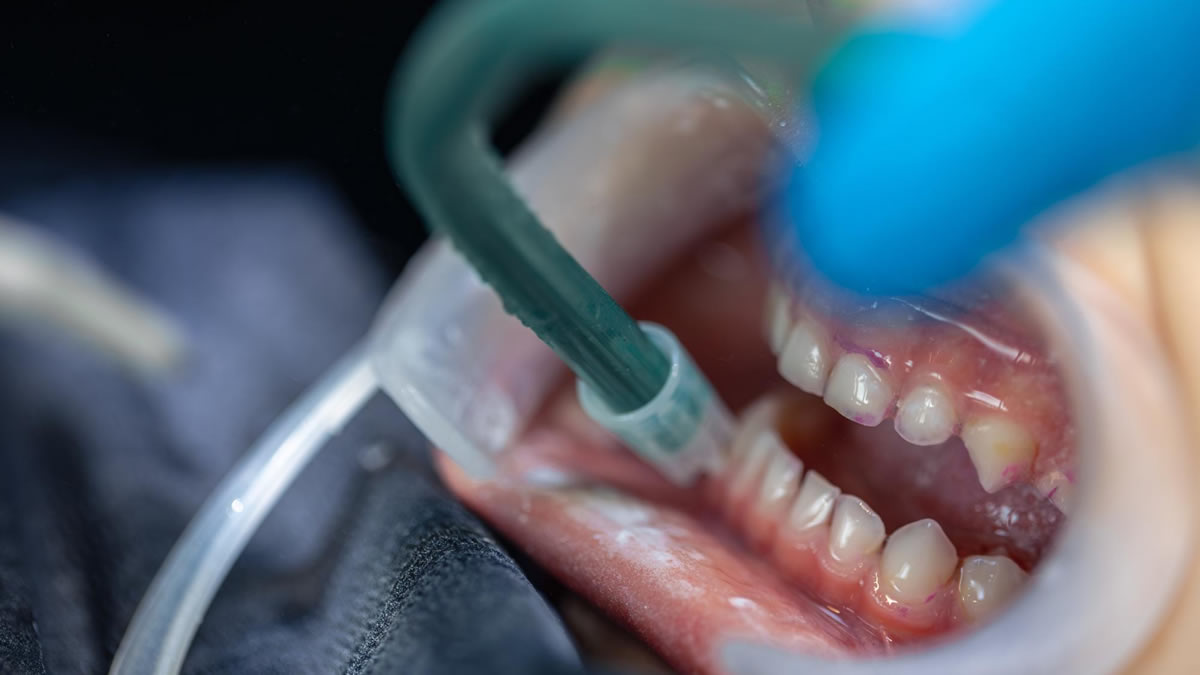 Periodontite: entenda a doença que afeta o osso dos dentes