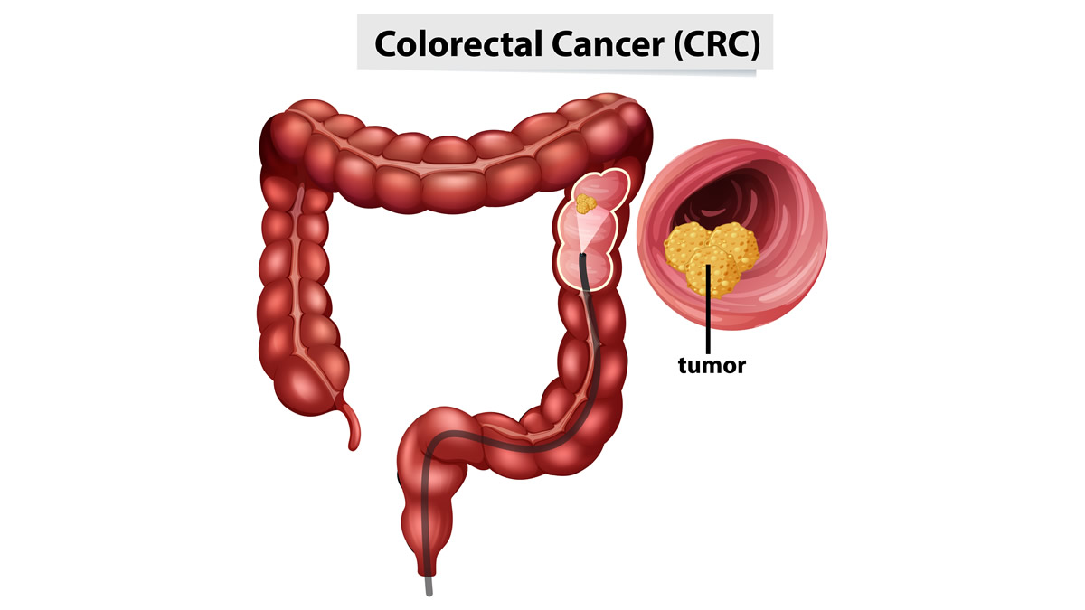 Desconhecimento e procrastinação: inimigos que transformam o câncer colorretal no segundo tumor de maior incidência no Brasil