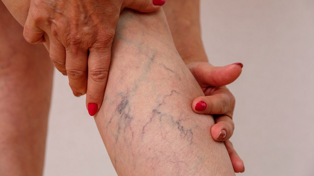 Varizes afetam 38% dos brasileiros e reforçam importância da prevenção das doenças vasculares